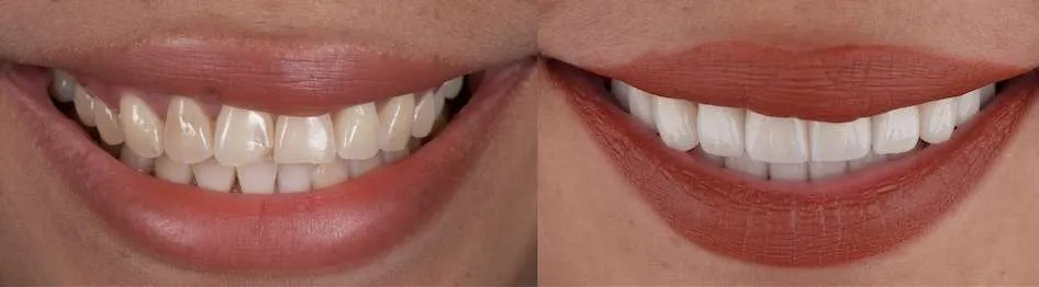 Before and after dental case 2
